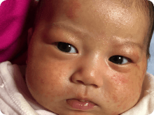 新生児ざ瘡(にきび) イメージ