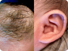 脂漏性皮膚炎 イメージ