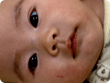 湿疹・アトピー性皮膚炎 イメージ