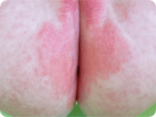 おむつかぶれ(おむつ皮膚炎) イメージ