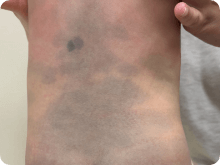 痣(あざ) イメージ